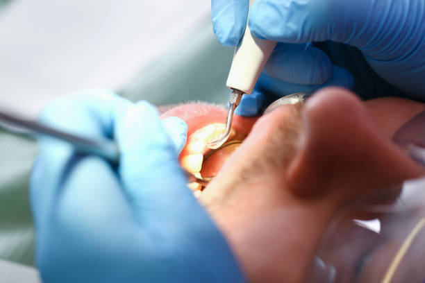 Best Knocked-Out Tooth (Avulsed Tooth) Treatment in St Ansgar, IA